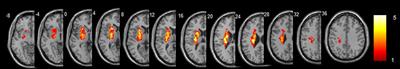 Aberrant interhemispheric functional reciprocities of the default mode network and motor network in subcortical ischemic stroke patients with motor impairment: A longitudinal study